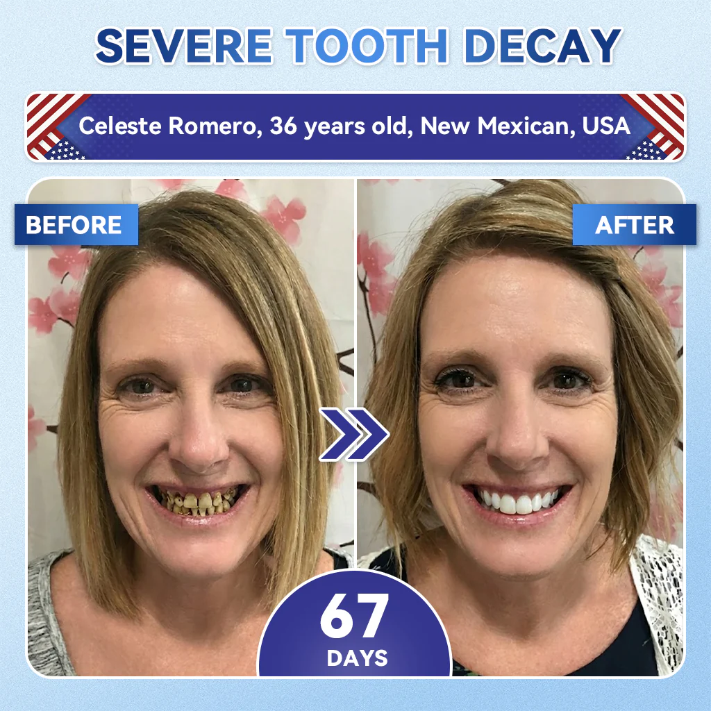 ใ๐๐๐๐ข๐๐ข๐๐ฅ ๐๐ ๐๐ญ๐จ๐ซ๐ ใZUEETยฎ ๐ฆท Tideglusib FastโDissolving Tooth & Gum Repair Oral Strips โจ (Supports tooth repair and helps relieve gum discomfort and other common oral concerns) - Image 4