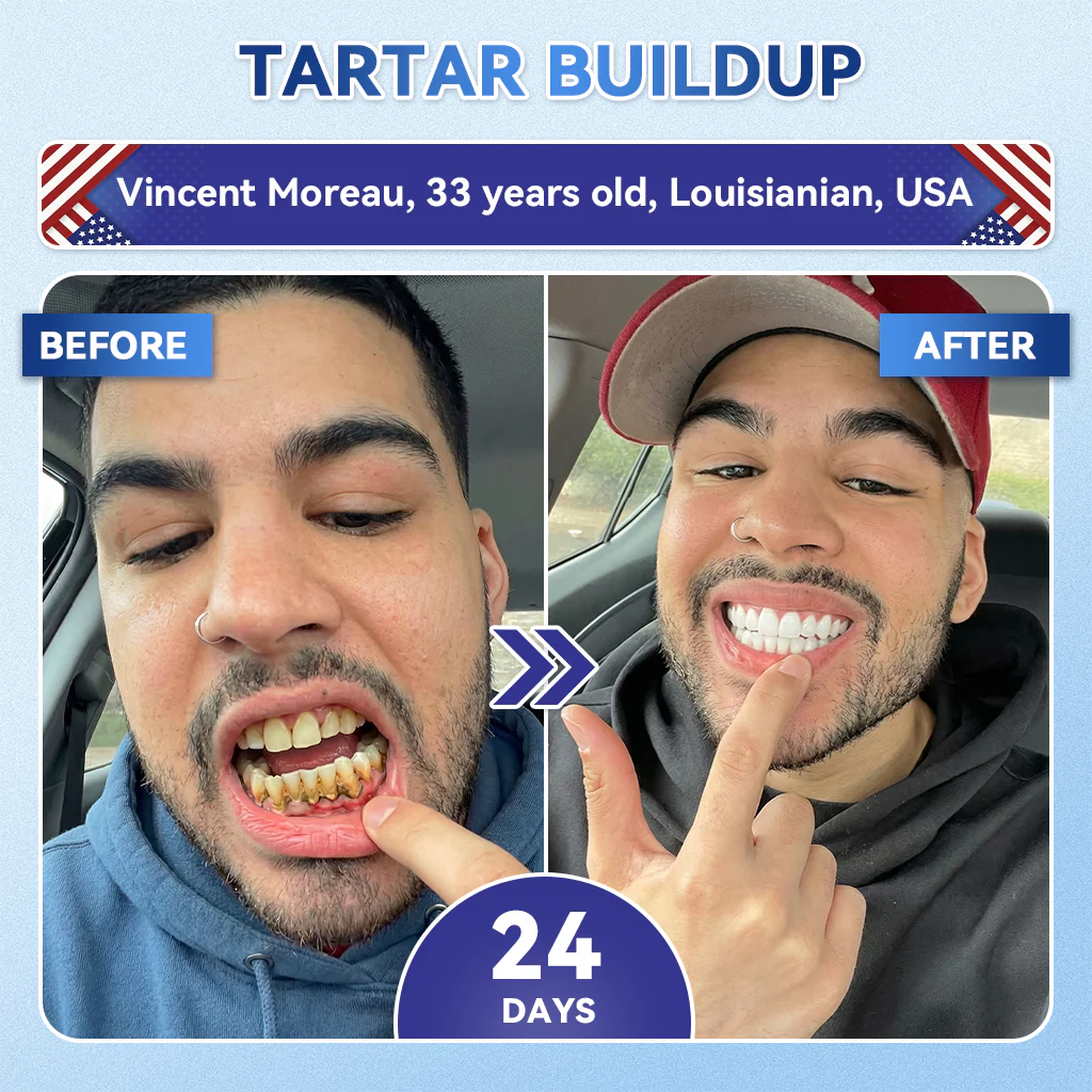 ใ๐๐๐๐ข๐๐ข๐๐ฅ ๐๐ ๐๐ญ๐จ๐ซ๐ ใZUEETยฎ ๐ฆท Tideglusib FastโDissolving Tooth & Gum Repair Oral Strips โจ (Supports tooth repair and helps relieve gum discomfort and other common oral concerns) - Image 6